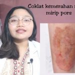 gejala kulit saat guladarah naik