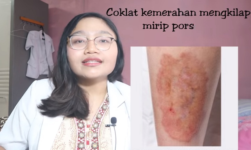 gejala kulit saat guladarah naik