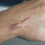 penyebab keloid membesar
