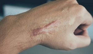 Penyebab Keloid Membesar dan Cara Mengatasinya