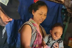 Titik Terang Hampiri Devi Shinta, Bayi 2 Tahun Asal Cianjur yang Sakit Meningokel