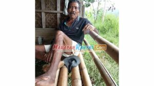 Kaki Kanan Seorang Pria di Ciamis Melepuh Usai Digigt Ular Hitam