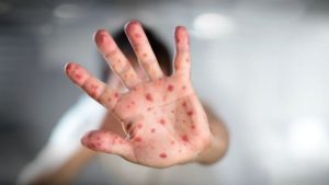 Cacar Monyet Sudah Masuk Indonesia, IDI Bentuk Satgas Monkeypox