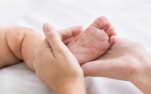 Dugaan Campak Jangkit Anak-anak di Tasikmalaya, Dinkes Lakukan Uji Laboratorium