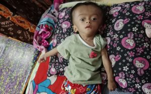 Ini Kisah Askyla Balita Penderita Hidrosefalus di Bandung yang Tak Tersentuh Pemerintah