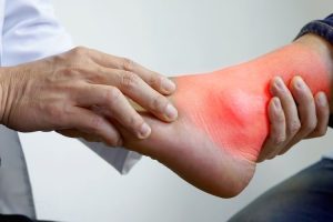 Asam Urat Sering Kambuh? Begini Cara Sederhana Mengatasinya